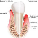 Zapalenie dziąseł