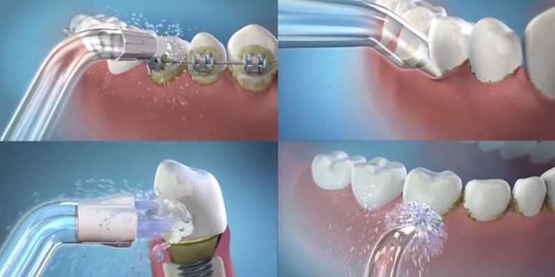 irygacja jamy ustnej irygatorem dentystycznym WATERPIK