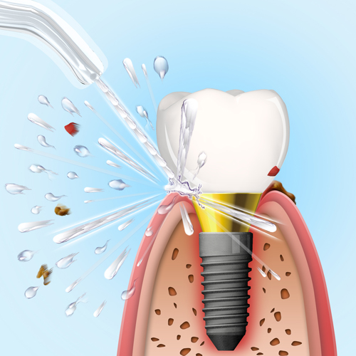 higiena implantów