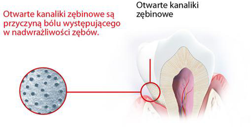 Nadwrażliwość zębów