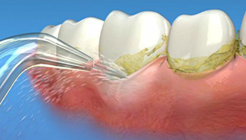 WATERPIK WJT-2E klasyczne końcówki do irygatora
