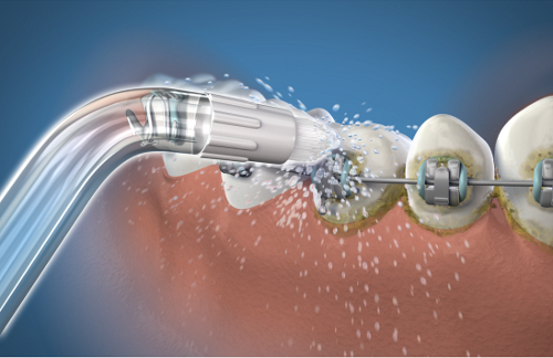 Waterpik OD-100 końcówki ortodontyczne do irygatorów Waterpik