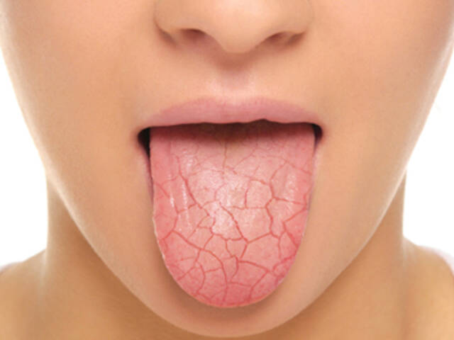 Kserostomia - choroba powodująca suchość jamy ustnej