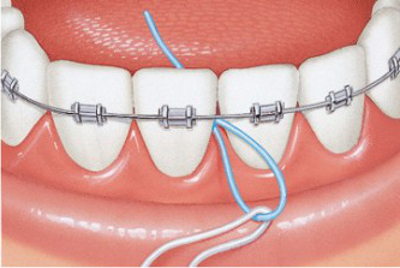 petelki-ortodontyczne-piksters-x-threader