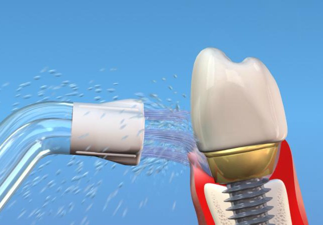 irygatory stomatologiczne do pielęgnacji implantów