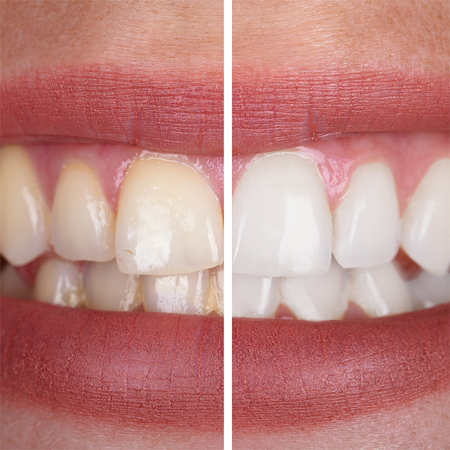 System wybielający Mr. Whitening System wybielający Mr. Whitening
