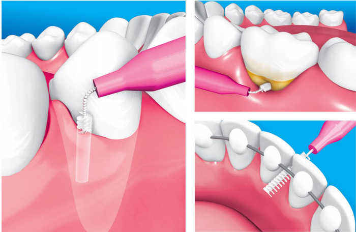 sposoby czyszczenia szczoteczkami międzyzębowymi