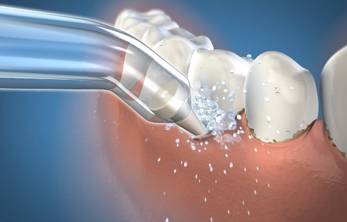 Waterpik PP-100 końcówki poddziąsłowe do irygatorów Waterpik Waterpik PP-100 końcówki poddziąsłowe do irygatorów Waterpik