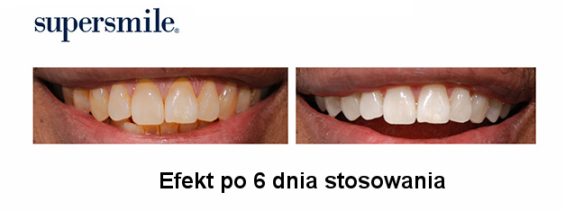 działanie wybielajace pasty do zębów SUPERSMILE